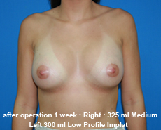 plastic-surgery-breast-augmentation